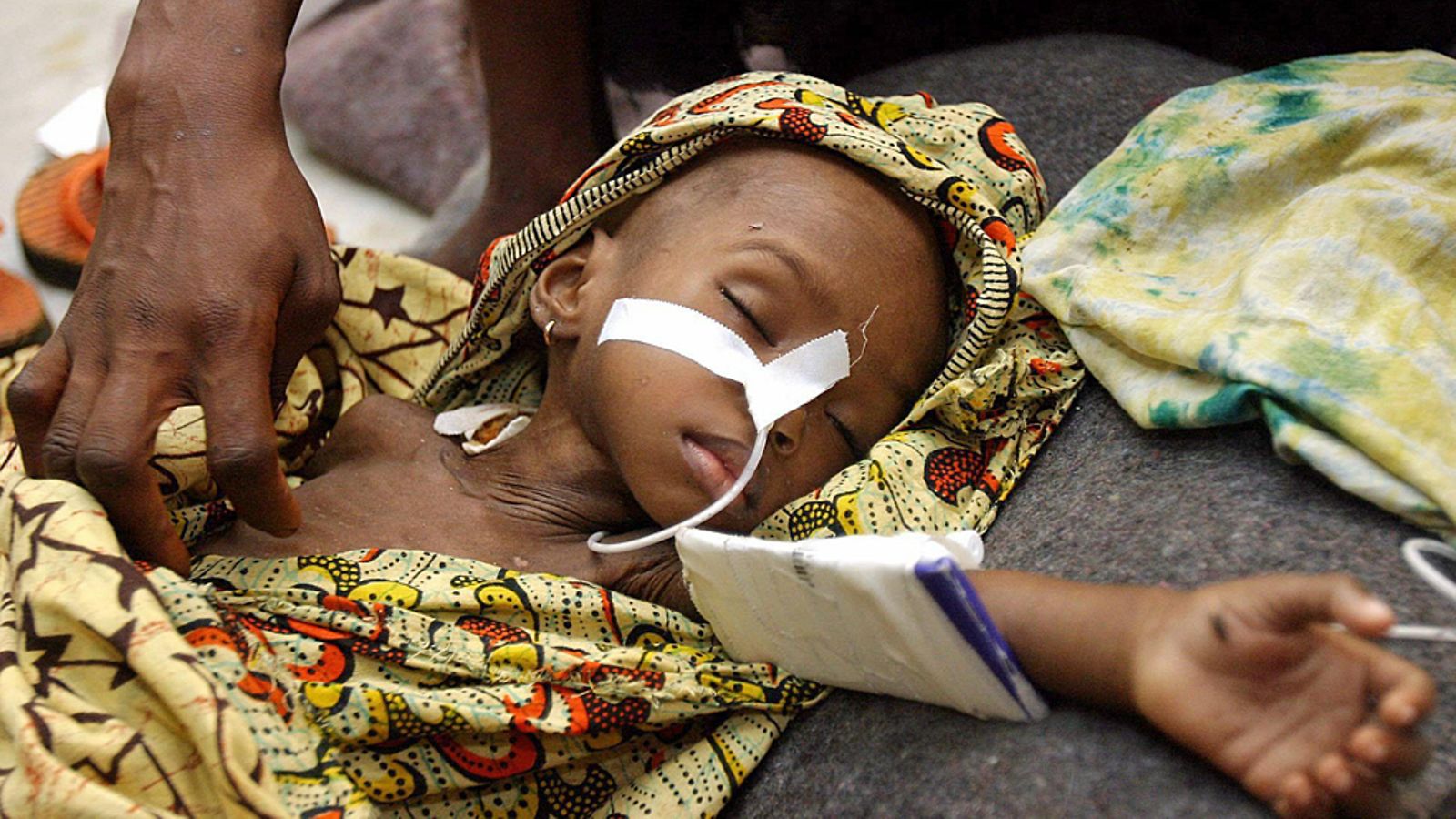 Liberialainen Edith Gboea oli hoidettavana Lääkärit ilman rajoja -järjestön klinikalla Liberian pääkaupungissa Monroviassa 28.7.2003. Gboea kärsi malariasta,hengitystieinfektiosta ja aliravitsemuksesta.
