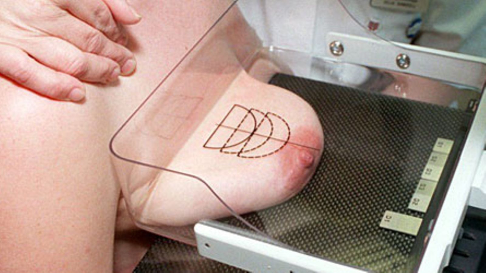 Mammografiassa. Kuva: Lehtikuva