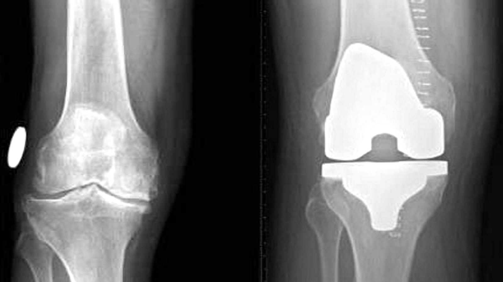 Röntgenkuva polvista. Vasemmalla polvi, jossa nivelrikko ja oikealla polvi tekonivelleikkauksen jälkeen.