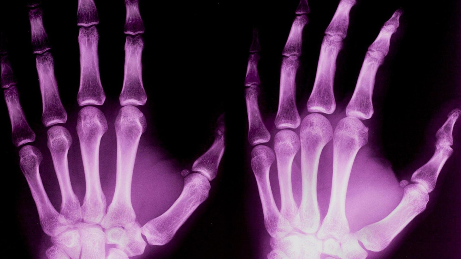 osteoporoosi