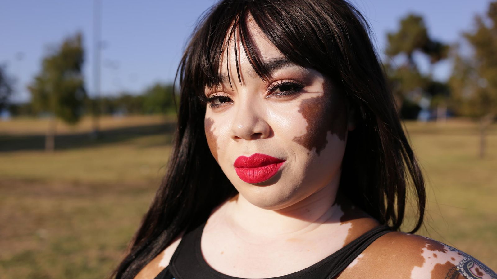 vitiligo