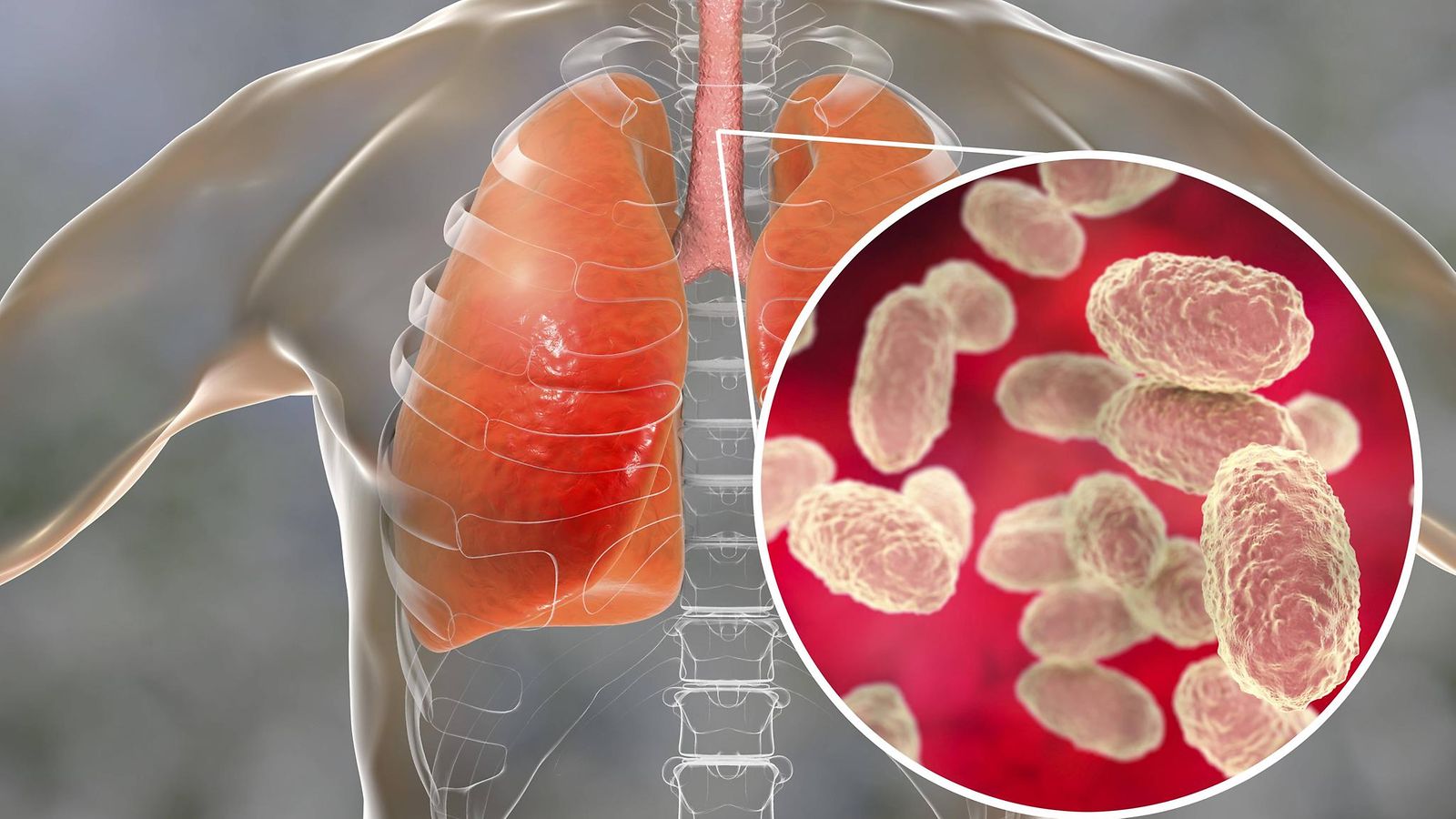 AOP Hinkuyskä on Bordetella pertussis -bakteerin aiheuttama erittäin tarttuva tartuntatauti. Tärkeimmät oireet ovat yskänkohtaukset ja hinkuva hengitysääni.