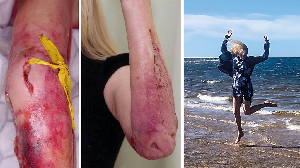 Mervi joutui teho-osastolle saatuaan naarmun joulukuusesta – "Jos mietit ambulanssin soittamista yöllä, soita!"