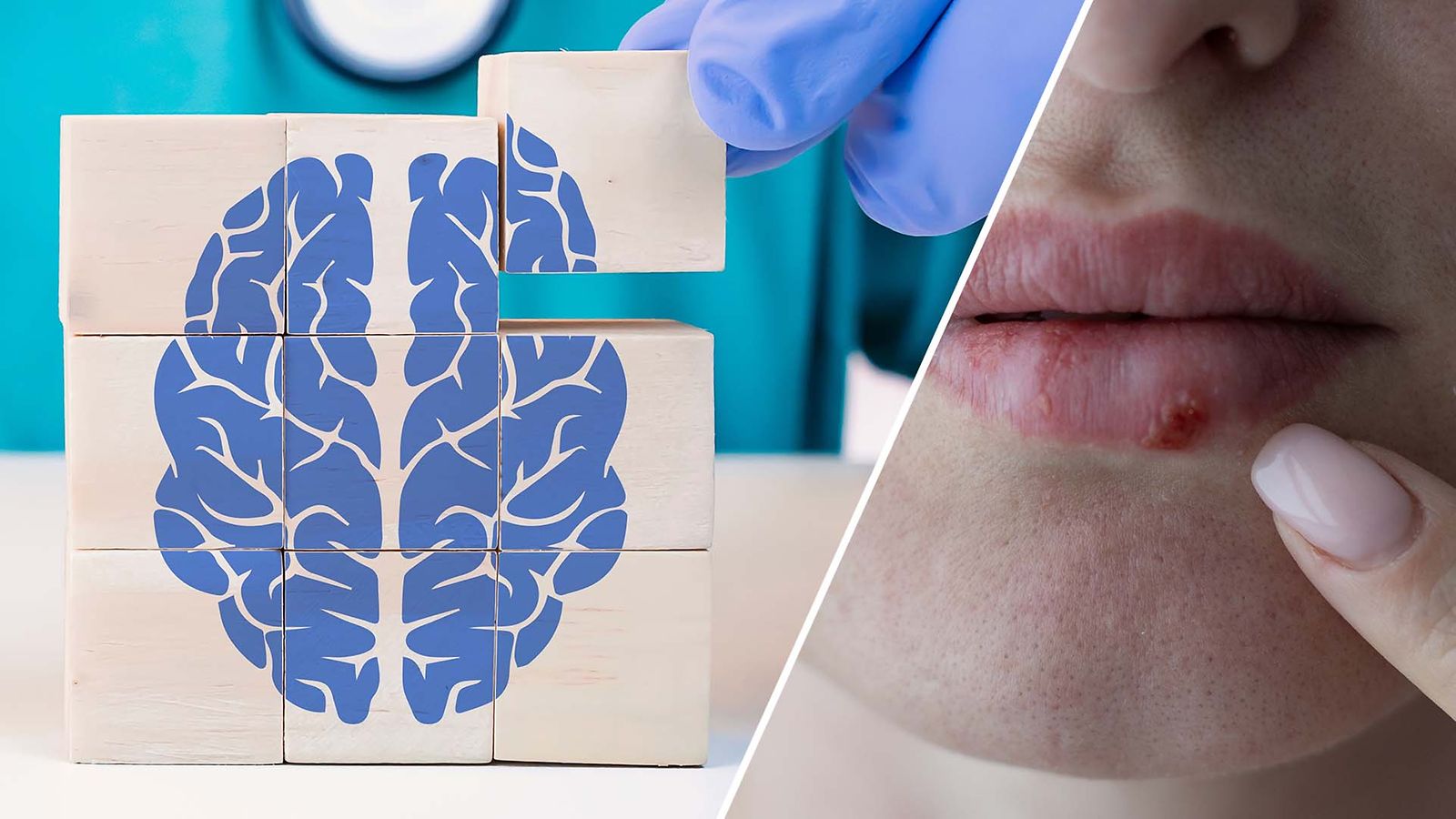 Herpes ja Alzheimer