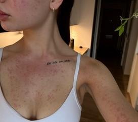 Wilma Rinkinen sai kesällä 2025 vakavan ihottuman Temusta tilatusta kuorimahanskasta. Kuvassa ihoreaktiota rinnalla ja kädessä.