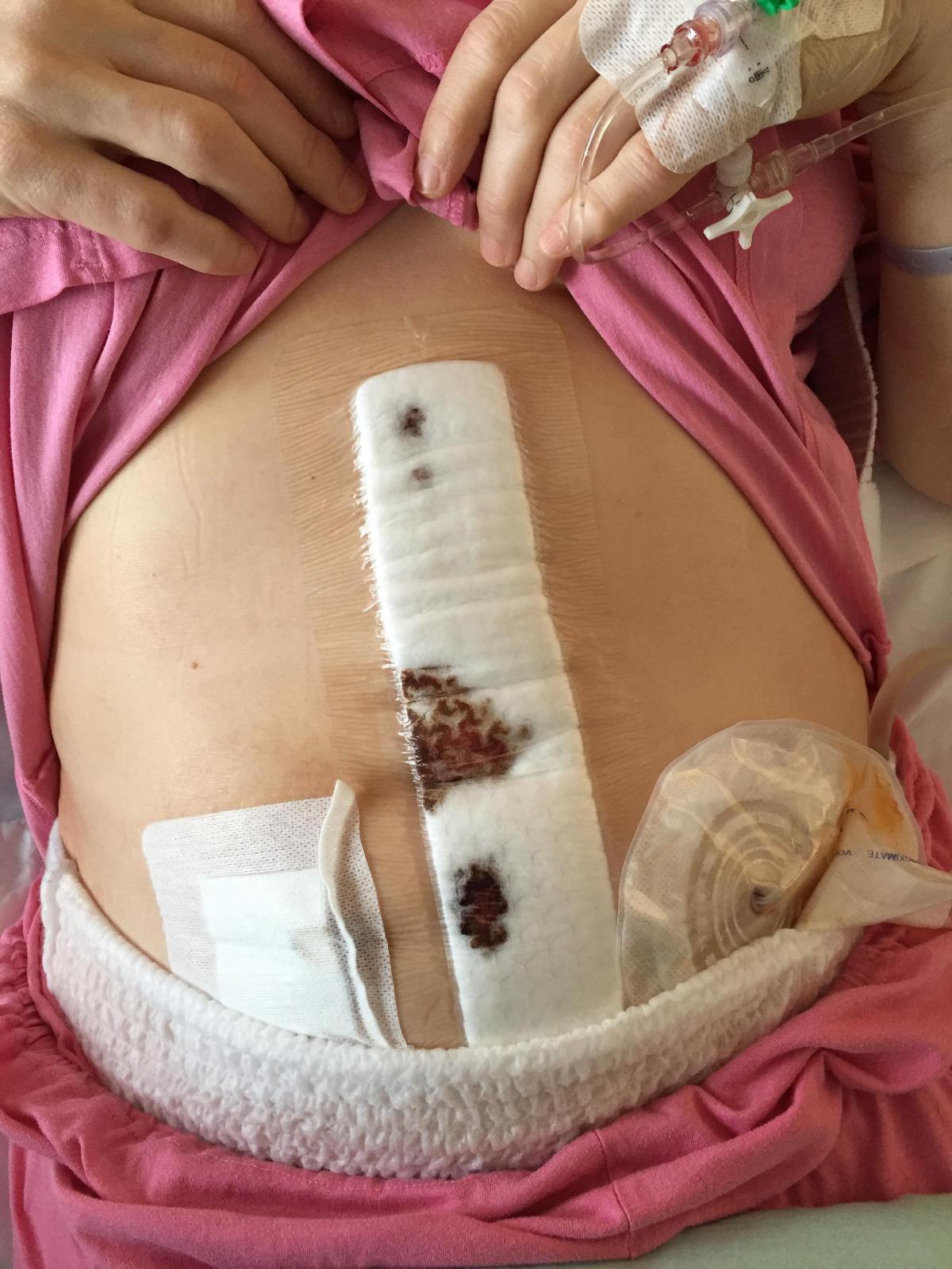 avanteen sulun jälkeen