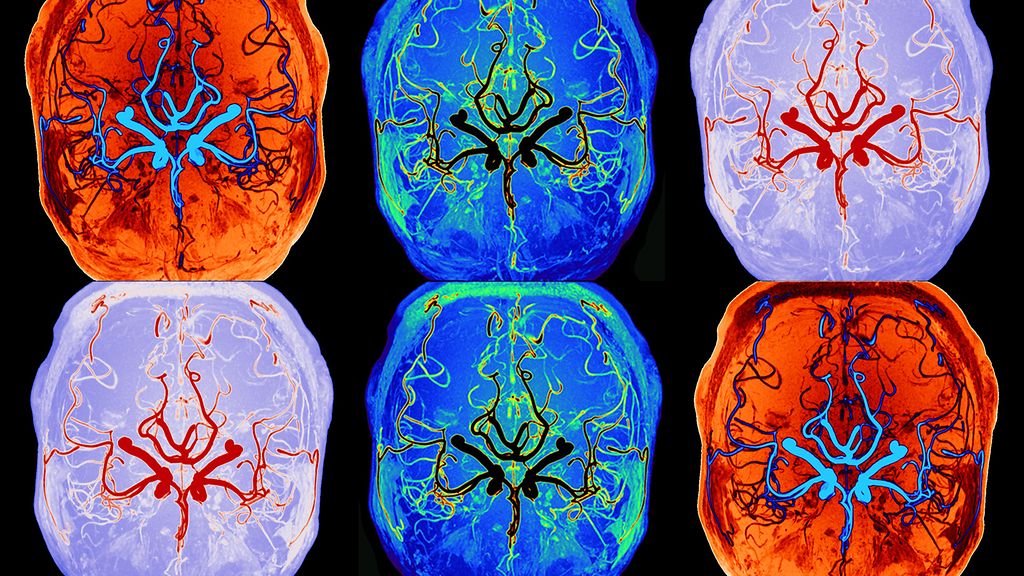 Uni puhdistaa aivoja – Oulun yliopisto löysi tavan mitata ilmiötä