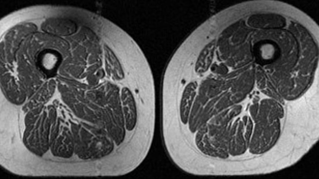 Kuin marmoroidut pihvit: Tämän ultraprosessoitu ruoka voi tehdä reisien lihaksille