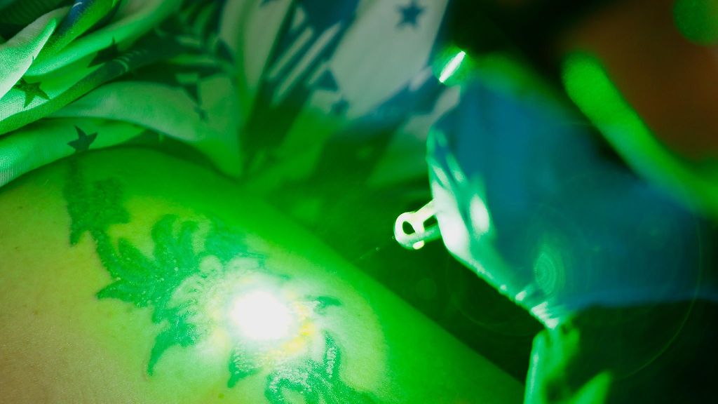 Tatuoinnin poisto ei ole helppo operaatio – aina iho ei palaa ennalleen