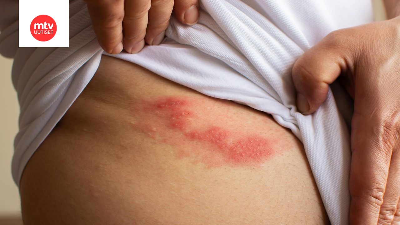 Can You Get Shingles If You Have Chicken Pox