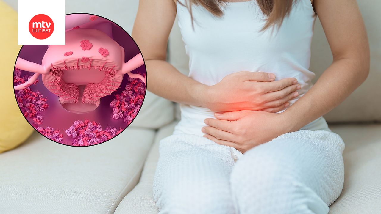 endometrioosin-syy-oireet-ja-hoito-mtv-uutiset